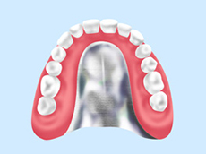 自費でつくる入れ歯